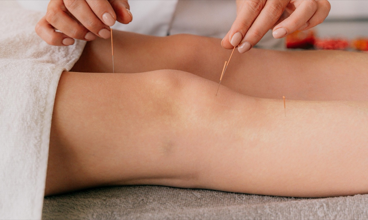Acupuncture needles placed around a patient's knee