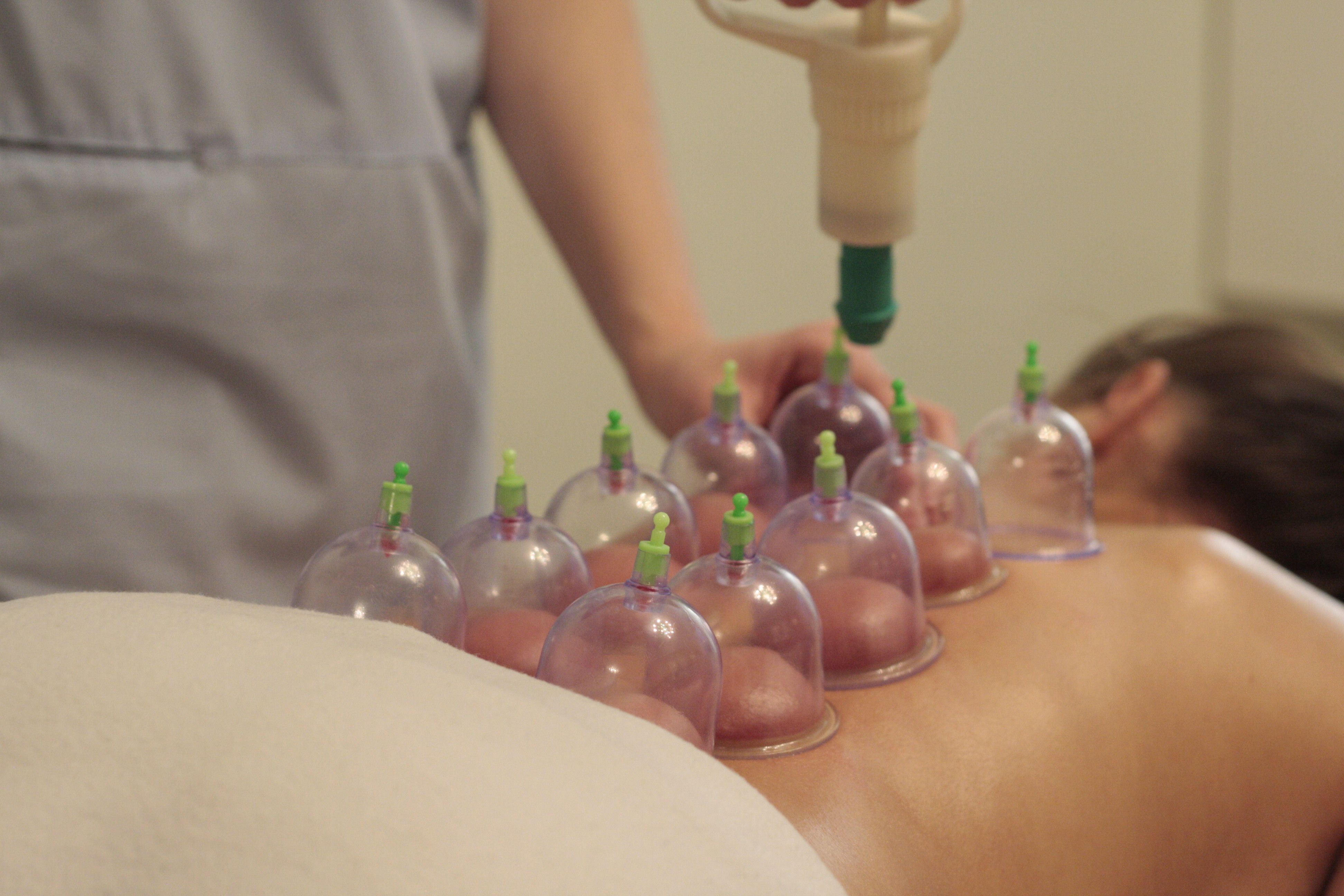 Cupping therapy cups applied to a patient's back